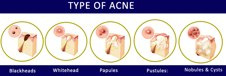 type of acne